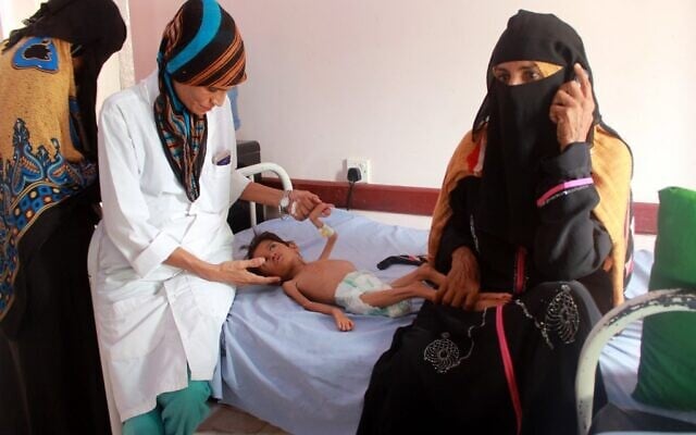 Une employée médicale examine un enfant yéménite souffrant de malnutrition, dans un centre de traitement de la province de Hajjah, dans le nord du Yémen, le 5 juillet 2020. (ESSA AHMED / AFP) Une employée médicale examine un enfant yéménite souffrant de malnutrition, dans un centre de traitement de la province de Hajjah, dans le nord du Yémen, le 5 juillet 2020. (ESSA AHMED / AFP)