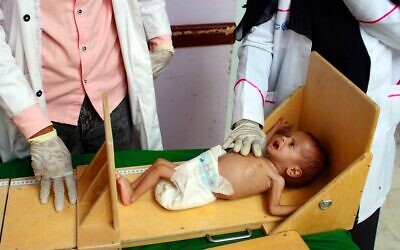 Un enfant yéménite souffrant de malnutrition est mesuré dans un centre de traitement dans la province de Hajjah, dans le nord du Yémen, le 5 juillet 2020. (ESSA AHMED / AFP)