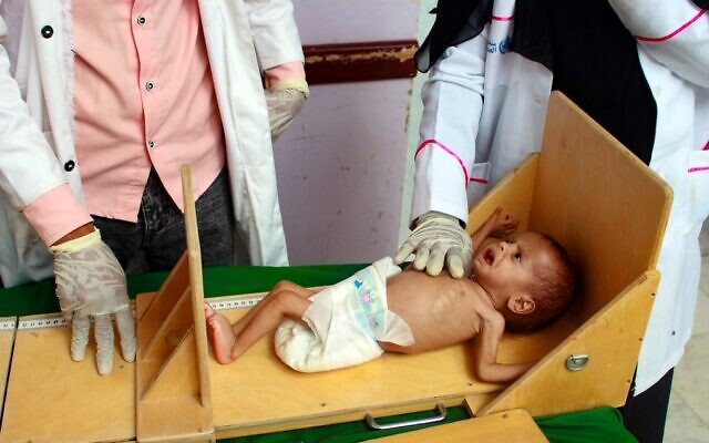 Un enfant yéménite souffrant de malnutrition est mesuré dans un centre de traitement dans la province de Hajjah, dans le nord du Yémen, le 5 juillet 2020. (ESSA AHMED / AFP)