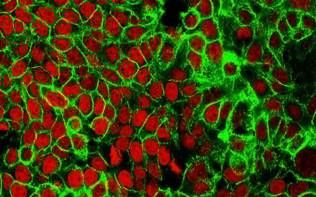 Cette image au microscope transmise par le Centre de recherche sur le cancer de l'Institut national du cancer montre des cellules cancéreuses implantées dans le côlon, avec leur noyau en rouge (Crédit : NCI Center for Cancer Research via AP) Cette image au microscope transmise par le Centre de recherche sur le cancer de l'Institut national du cancer montre des cellules cancéreuses implantées dans le côlon, avec leur noyau en rouge (Crédit : NCI Center for Cancer Research via AP)