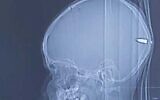 Image radiographique d'une balle logée dans le cerveau d'un garçon de 9 ans à l'hôpital universitaire Hadassah de Jérusalem, le 31 juillet 2020. (Avec l'aimable autorisation de l'hôpital universitaire Hadassah)