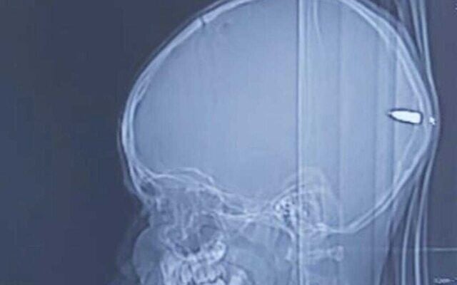 Image radiographique d'une balle logée dans le cerveau d'un garçon de 9 ans à l'hôpital universitaire Hadassah de Jérusalem, le 31 juillet 2020. (Avec l'aimable autorisation de l'hôpital universitaire Hadassah) Image radiographique d'une balle logée dans le cerveau d'un garçon de 9 ans à l'hôpital universitaire Hadassah de Jérusalem, le 31 juillet 2020. (Avec l'aimable autorisation de l'hôpital universitaire Hadassah)