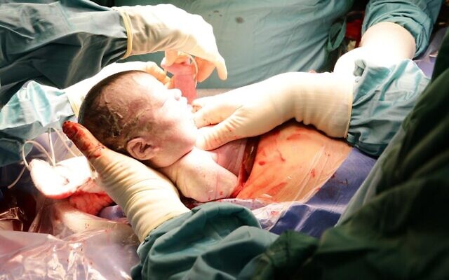 Le bébé né le 14 octobre 2020, après une procédure ex utero intrapartum au Centre médical Sourasky de Tel Aviv (avec l'aimable autorisation du Centre médical Sourasky de Tel Aviv) Le bébé né le 14 octobre 2020, après une procédure ex utero intrapartum au Centre médical Sourasky de Tel Aviv (avec l'aimable autorisation du Centre médical Sourasky de Tel Aviv)