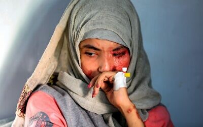 Al-Anoud Hussein Chariane, jeune fille de 19 ans défigurée par une attaque à l'acide par son mari violent, à l’hôpital où elle est soignée à Sanaa, capitale du Yémen, le 28 janvier 2021. (Crédit : Mohammed HUWAIS / AFP) Al-Anoud Hussein Chariane, jeune fille de 19 ans défigurée par une attaque à l'acide par son mari violent, à l’hôpital où elle est soignée à Sanaa, capitale du Yémen, le 28 janvier 2021. (Crédit : Mohammed HUWAIS / AFP)
