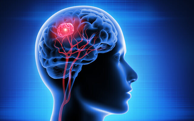 Illustration d'une tumeur cérébrale causée par un glioblastome. (peterschreiber.media via iStock by Getty Images) Illustration d'une tumeur cérébrale causée par un glioblastome. (peterschreiber.media via iStock by Getty Images)