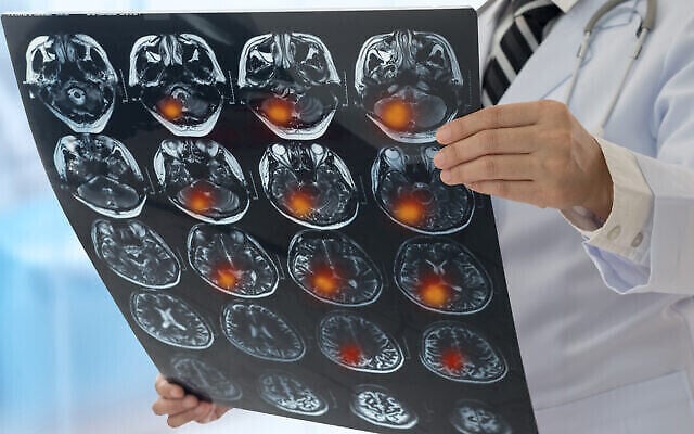 Un médecin examine l'image de radiographie du cerveau du patient obtenue par IRM. Illustration (Crédit : utah778/iStock by Getty Images)