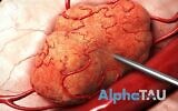Illustration de la manière dont une aiguille contenant des particules alpha est insérée dans une tumeur solide ; Alpha Tau Medical affirme avoir développé une technologie dans laquelle ces particules alpha peuvent vivre suffisamment longtemps pour détruire les cellules(Crédit : Courtesy) 