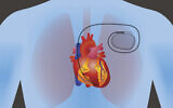 Photo d'illustration : Un pacemaker dans le corps humain. (Crédit : Chombosan via iStock by Getty Images)