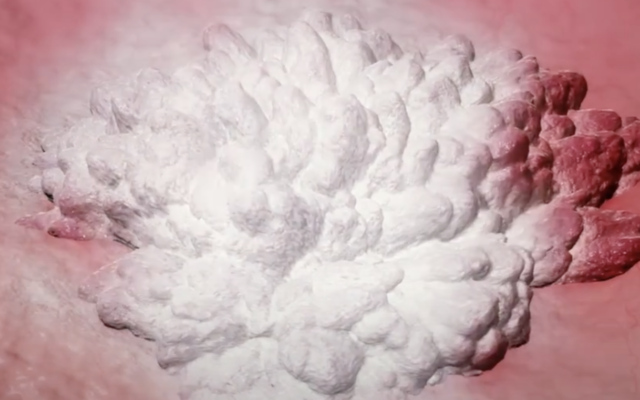 Un nouveau produit qui gèle les cellules cancéreuses, utilisé dans les cancers de la vessie. (Capture d'écran : Vessi Medical) Un nouveau produit qui gèle les cellules cancéreuses, utilisé dans les cancers de la vessie. (Capture d'écran : Vessi Medical)