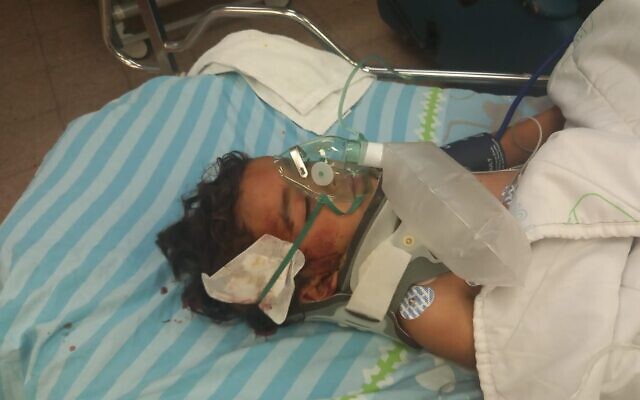 Mohammad Bakr Hussein, 3 ans aurait été blessé par des pierres jetées par des habitants d'implantation israéliens dans le sud des collines de Hébron, le 28 septembre 2021. (Crédit : autorisation) Mohammad Bakr Hussein, 3 ans aurait été blessé par des pierres jetées par des habitants d'implantation israéliens dans le sud des collines de Hébron, le 28 septembre 2021. (Crédit : autorisation)