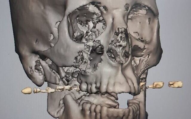 Imagerie 3D de la mâchoire de "Dalet" après la blessure, avec la balle représentée. (Autorisation : Rambam Healthcare Campus) Imagerie 3D de la mâchoire de "Dalet" après la blessure, avec la balle représentée. (Autorisation : Rambam Healthcare Campus)