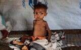 Randa, un bébé yéménite souffrant de malnutrition sévère, attend d'être soigné dans un centre géré par une organisation humanitaire, à l'intérieur d'un camp de personnes déplacées ayant fui les combats entre les rebelles Huthi et le gouvernement soutenu par l'Arabie saoudite, dans le district d'Abs, dans la province de Hajjah. (Crédit : ESSA AHMED / AFP).