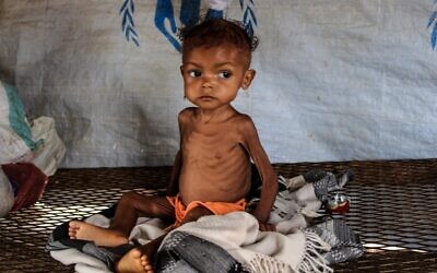 Randa, un bébé yéménite souffrant de malnutrition sévère, attend d'être soigné dans un centre géré par une organisation humanitaire, à l'intérieur d'un camp de personnes déplacées ayant fui les combats entre les rebelles Huthi et le gouvernement soutenu par l'Arabie saoudite, dans le district d'Abs, dans la province de Hajjah. (Crédit : ESSA AHMED / AFP).