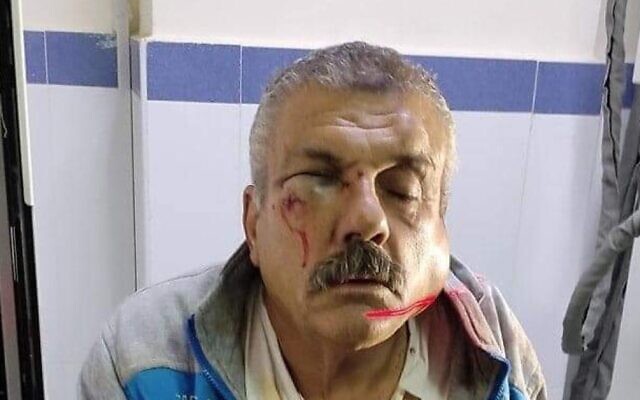 Wael Moqbel, un habitant du village de Qaryut qui aurait été attaqué par des colons extrémistes le 17 décembre 2021. (Autorisation) Wael Moqbel, un habitant du village de Qaryut qui aurait été attaqué par des colons extrémistes le 17 décembre 2021. (Autorisation)