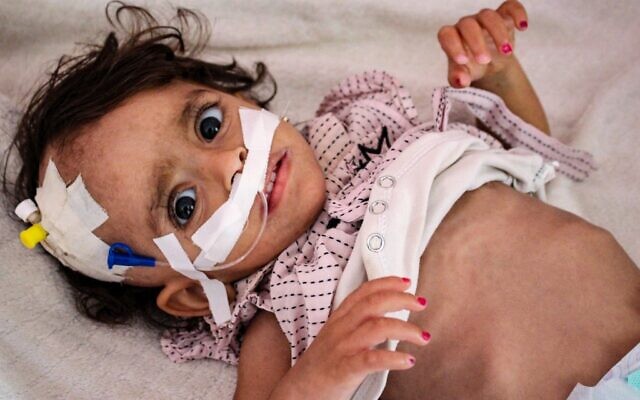 Un enfant souffrant de malnutrition reçoit un traitement à l'hôpital Al-Sadaqa dans la ville d'Aden, dans le sud du Yémen, le 26 février 2022. (Crédit : Saleh OBAIDI / AFP) Un enfant souffrant de malnutrition reçoit un traitement à l'hôpital Al-Sadaqa dans la ville d'Aden, dans le sud du Yémen, le 26 février 2022. (Crédit : Saleh OBAIDI / AFP)