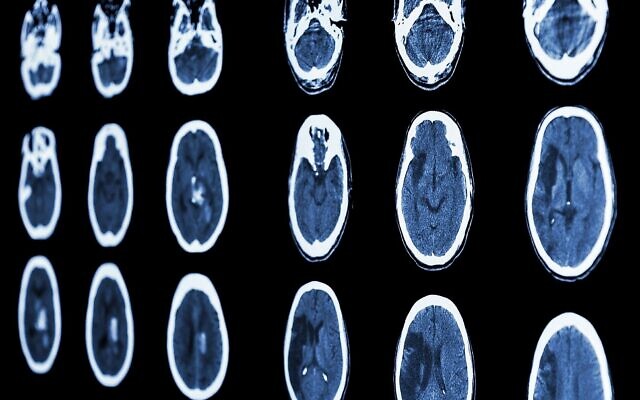 Un scanner illustratif d'un cerveau montre un AVC ischémique et un AVC hémorragique. (Crédit: stockdevil; iStock par Getty Images) Un scanner illustratif d'un cerveau montre un AVC ischémique et un AVC hémorragique. (Crédit: stockdevil; iStock par Getty Images)