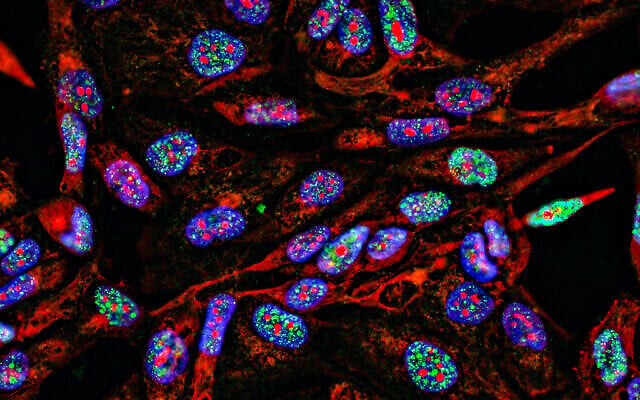 Immunofluorescence des cellules cancéreuses par imagerie fluorescente en 2D avec les noyaux (spécifiquement l’ADN) en bleu, le cytoplasme (le liquide gélatineux qui remplit la cellule) en rouge, et les dommages causés à l’ADN en vert. (Crédit : Nicola Ferrari via iStock par Getty Images)