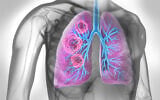 Illustration d'un cancer du poumon, avec une zone cancéreuse dans les poumons (Crédit : peterschreiber.media via iStock by Getty Images)