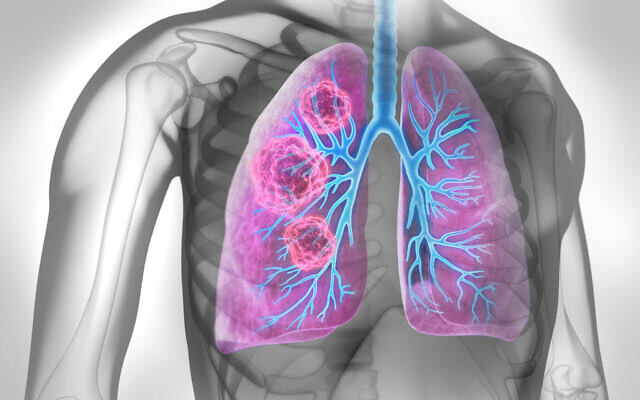 Illustration d'un cancer du poumon, avec une zone cancéreuse dans les poumons (Crédit : peterschreiber.media via iStock by Getty Images) Illustration d'un cancer du poumon, avec une zone cancéreuse dans les poumons (Crédit : peterschreiber.media via iStock by Getty Images)