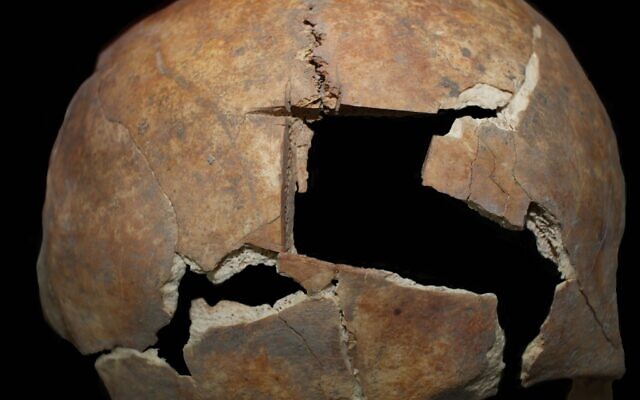 Une vue rapprochée de la procédure de tréphination et du morceau de crâne qui a été retiré découvert à Tel Megiddo, dans le nord d'Israël. (Crédit : Rachel Kalisher) Une vue rapprochée de la procédure de tréphination et du morceau de crâne qui a été retiré découvert à Tel Megiddo, dans le nord d'Israël. (Crédit : Rachel Kalisher)
