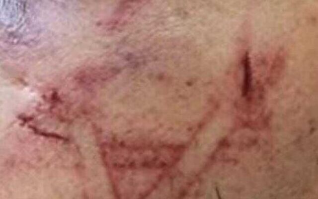 Des marques de coupure sur le visage d'un détenu palestinien qui, selon les forces de l'ordre, ont été causées par la chaussure d'un policier, l'avocat du suspect affirme que la police l'a marqué d'une étoile de David, sur photo publiée par la police le 19 août 2023. (Crédit : Police israélienne) Des marques de coupure sur le visage d'un détenu palestinien qui, selon les forces de l'ordre, ont été causées par la chaussure d'un policier, l'avocat du suspect affirme que la police l'a marqué d'une étoile de David, sur photo publiée par la police le 19 août 2023. (Crédit : Police israélienne)