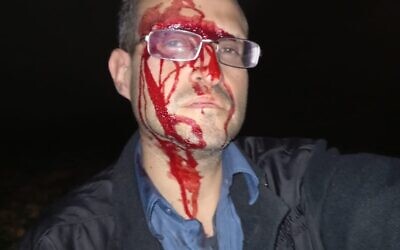Alex Povolotsky, activiste du groupe  Jordan Valley Activists, après avoir été attaqué par des partisans présumés du mouvement pro-implantations dans le hameau palestinien de Farasiya, en Cisjordanie, le 4 décembre 2023. (Crédit  : Jordan Valley Activists)