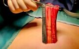 Des chirurgiens de l'hôpital universitaire Samson Assuta d'Ashdod retirant les tissus d'un énorme kyste chez une jeune fille de 12 ans, en janvier 2024. (Crédit : Hôpital Assuta)