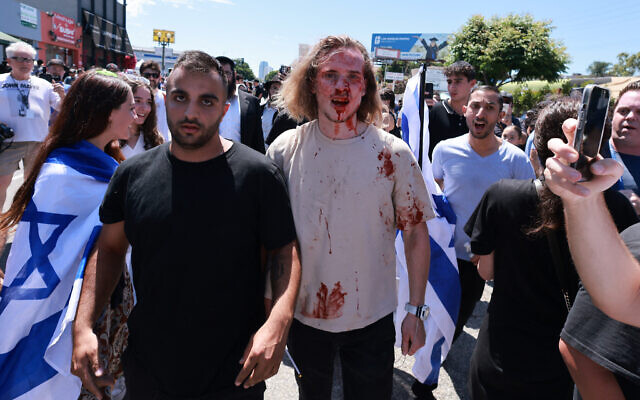 Un partisan d'Israël avec du sang sur le visage après avoir affronté des manifestants anti-Israël qui bloquaient l'accès à la synagogue orthodoxe Adas Torah, à Los Angeles, le 23 juin 2024. (Crédit : David Swanson/AFP)