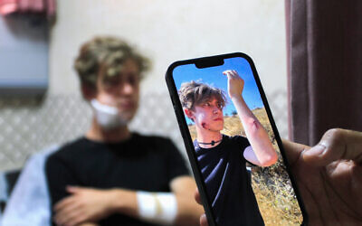 Un militant pro-palestinien étranger soigné à l'hôpital Rafidia de Naplouse, après avoir été attaqué par des résidents d’implantations israéliens juifs dans le village de Qusra, en Cisjordanie, le 21 juillet 2024. (Crédit : Nasser Ishtayeh/Flash90)