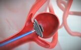La startup israélienne Endostream Medical développe un dispositif médical pour le traitement des anévrismes cérébraux. (Crédit : Autorisation)