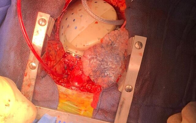 Un cœur artificiel est implanté à un patient de l’hôpital Hadassah Ein Kerem de Jérusalem, sur une image publiée le 29 mai 2025. (Hôpital Hadassah Ein Kerem) Un cœur artificiel est implanté à un patient de l’hôpital Hadassah Ein Kerem de Jérusalem, sur une image publiée le 29 mai 2025. (Hôpital Hadassah Ein Kerem)