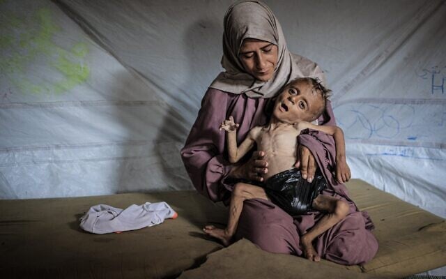 Muhammad Zakariya Ayyoub al-Matouq, un enfant d'un an et demi vivant à Gaza-City, confronté à une malnutrition qui met sa vie en danger alors que la situation humanitaire s'aggrave, le 21 juillet 2025. (Crédit : Ahmed Jihad Ibrahim Al-arini/Anadolu via Reuters)