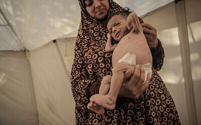 Salim Mahmoud Awad, sept mois, souffre d'une perte de poids importante en raison de la pénurie de lait maternisé et de nourriture pour bébé après avoir été déplacé vers Gaza-City avec sa famille, le 26 juillet 2025. (Crédit : Ahmed Jihad Ibrahim al-Arini/Anadolu via Reuters Connect)