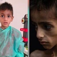 Montage photos (de gauche à droite) : Osama al-Rakab, 5 ans, recevant des soins médicaux ; une photo du même enfant atteint d'une maladie génétique, utilisée pour accuser Israël d'affamer les enfants à Gaza. (Crédit : Capture d’écran via X ; COGAT)