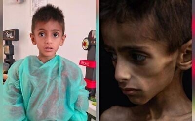 Montage photos (de gauche à droite) : Osama al-Rakab, 5 ans, recevant des soins médicaux ; une photo du même enfant atteint d'une maladie génétique, utilisée pour accuser Israël d'affamer les enfants à Gaza. (Crédit : Capture d’écran via X ; COGAT)
