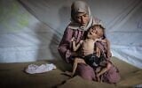Mohammed al-Mutawaq, enfant âgé d'un an et demi et originaire de la ville de Gaza, à Gaza, serait atteint d'une maladie musculaire mortelle et de malnutrition, le 21 juillet 2025. (Ahmed Jihad Ibrahim Al-arini / Anadolu, via Reuters)