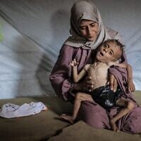 Mohammed al-Mutawaq, enfant âgé d'un an et demi et originaire de la ville de Gaza, à Gaza, serait atteint d'une maladie musculaire mortelle et de malnutrition, le 21 juillet 2025. (Ahmed Jihad Ibrahim Al-arini / Anadolu, via Reuters)