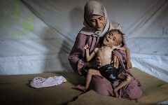 Mohammed al-Mutawaq, enfant âgé d'un an et demi et originaire de la ville de Gaza, à Gaza, serait atteint d'une maladie musculaire mortelle et de malnutrition, le 21 juillet 2025. (Ahmed Jihad Ibrahim Al-arini / Anadolu, via Reuters)