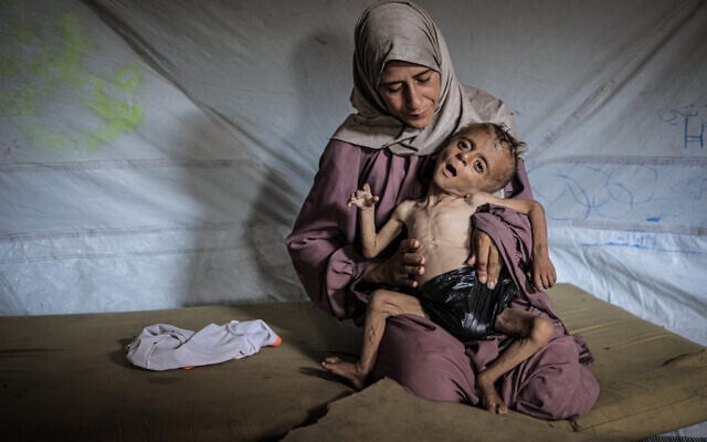 Mohammed al-Mutawaq, enfant âgé d'un an et demi et originaire de la ville de Gaza, à Gaza, serait atteint d'une maladie musculaire mortelle et de malnutrition, le 21 juillet 2025. (Ahmed Jihad Ibrahim Al-arini / Anadolu, via Reuters)