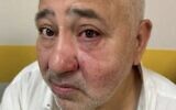 Dov Sitruk après son agression le 9 août 2025. (Crédit : Dov Sitruk)
