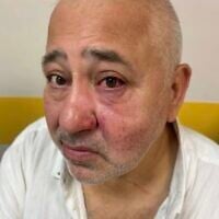 Dov Sitruk après son agression le 9 août 2025. (Crédit : Dov Sitruk)