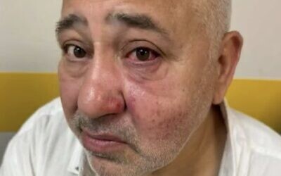 Dov Sitruk après son agression le 9 août 2025. (Crédit : Dov Sitruk)