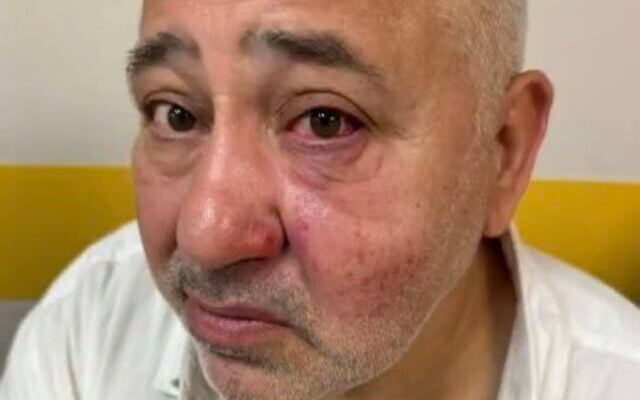 Dov Sitruk après son agression le 9 août 2025. (Crédit : Dov Sitruk)