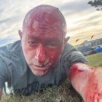 Arsen Ostrovsky, qui se trouvait avec sa famille à Bondi Beach, à Sydney, lors de la fusillade terroriste meurtrière du 14 décembre 2025, sur une photo qu'il a ensuite mise à disposition. La tête pansée, il a ensuite décrit l'attaque dans une interview à la télévision australienne. (Crédit : Arsen Ostrovsky)