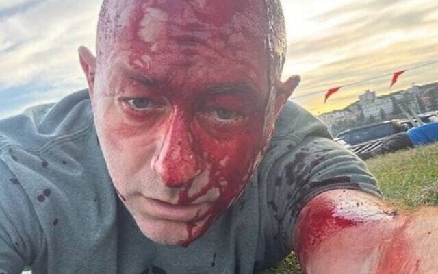 Arsen Ostrovsky, qui se trouvait avec sa famille à Bondi Beach, à Sydney, lors de la fusillade terroriste meurtrière du 14 décembre 2025, sur une photo qu'il a ensuite mise à disposition. La tête pansée, il a ensuite décrit l'attaque dans une interview à la télévision australienne. (Crédit : Arsen Ostrovsky)