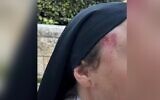 Des ecchymoses sur le visage d'une nonne à la suite d'une agression présumée, à Jérusalem, le 29 avril 2026. (Crédit : Police israélienne)