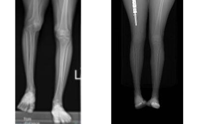 Une femme de 24 ans (à gauche), atteinte de la maladie de Gorham-Stout, également appelée « ostéolyse », qui a entraîné un raccourcissement notable de sa jambe droite par rapport à la gauche, avant le traitement ; (à droite) avec l'implant d'allongement de la jambe dans la cuisse. (Crédit : Hôpital Hadassah)