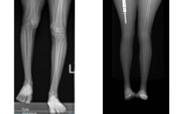 Une femme de 24 ans (à gauche), atteinte de la maladie de Gorham-Stout, également appelée « ostéolyse », qui a entraîné un raccourcissement notable de sa jambe droite par rapport à la gauche, avant le traitement ; (à droite) avec l'implant d'allongement de la jambe dans la cuisse. (Crédit : Hôpital Hadassah)