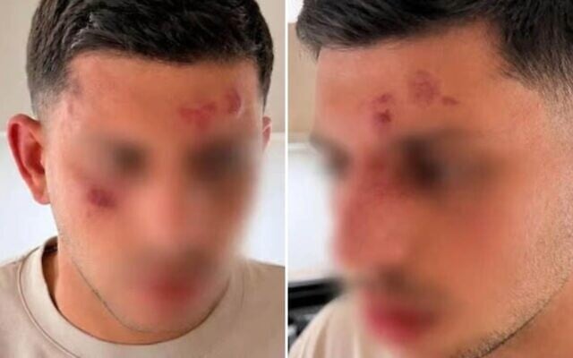 Shalev Ben Yakar après avoir été violemment agressé dans le quartier de Golders Green, à Londres, le 18 mai 2026. (Crédit : Capture d'écran/X/Ynet) Shalev Ben Yakar après avoir été violemment agressé dans le quartier de Golders Green, à Londres, le 18 mai 2026. (Crédit : Capture d'écran/X/Ynet)