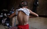Une fillette gazaouie déplacée, qui, selon des médecins, souffre de la varicelle, à l'intérieur de la tente familiale, à Khan Younès, dans le sud de la bande de Gaza, le 19 juillet 2026. (Crédit : Bashar Taleb/AFP)